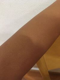 腕に白い斑点 みたいなものがあります 毛穴が白くなっている Yahoo 知恵袋