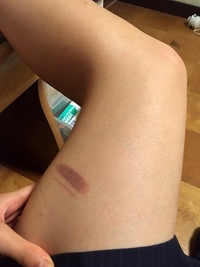 画像あり 太ももを火傷しました ヘアアイロンです 痛くもなんと Yahoo 知恵袋