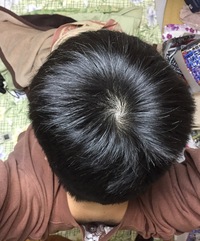 私の頭頂部 つむじ周り 完璧に禿げていますよね 性別は男 年齢は Yahoo 知恵袋