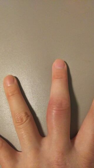 本 腫れる 一 だけ が 指