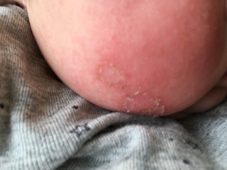 赤ちゃんの頬のかぶれ生後4ヶ月の赤ちゃんですが 乳児湿疹が落ち着いたと思っ Yahoo 知恵袋
