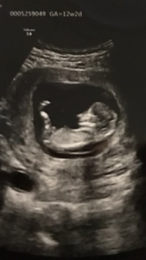 妊婦健診でのエコー写真のntについて今日妊娠12w2dで妊婦健診 Yahoo 知恵袋