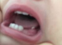 １歳５ヶ月の子供の歯茎が変なんです 説明が難しいのですが奥の歯茎がめくれて Yahoo 知恵袋