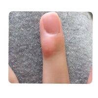 中指のペンだこを治したいです 中2女子です 小学6年生頃から右の中指にペ Yahoo 知恵袋