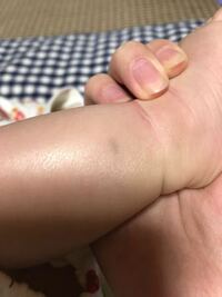 赤ちゃんは生後どれくらいからそばかすができはじめますか 生後6ヶ月の赤 Yahoo 知恵袋