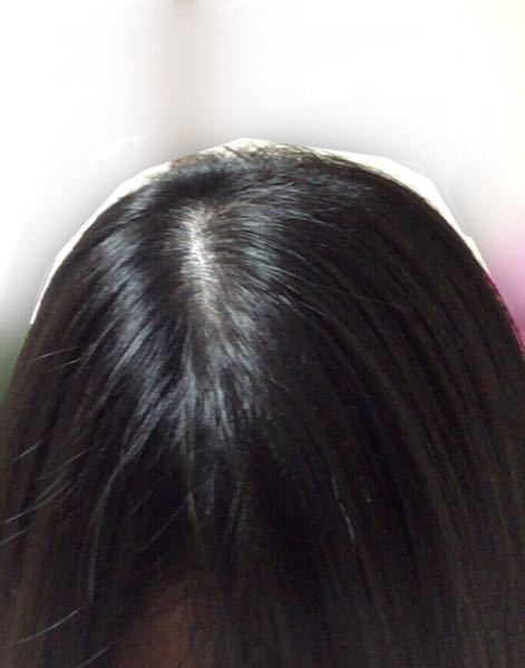 つむじ ハゲ 女