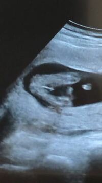 妊娠14週でのエコー画像ですが これは男の子で間違いないでしょうか Yahoo 知恵袋