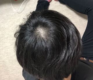つむじを新しく作ることは不可能なのでしょうか それと ハゲ隠しの粉や Yahoo 知恵袋