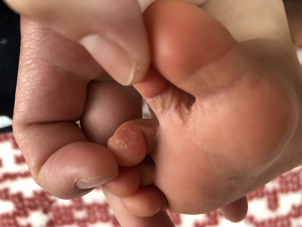 これ 水虫かわかりますか 10ヶ月の乳児の足です 手や爪は何とも Yahoo 知恵袋
