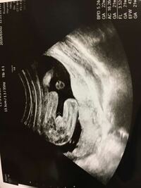 妊娠21週目です 赤ちゃんの性別について このエコー写真は Yahoo 知恵袋