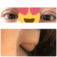 二重幅の修正をしたいです 去年の11月に全切開をしました 先生とのフィーリ Yahoo 知恵袋