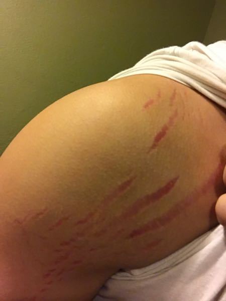 画像をダウンロード 肉 割れ 二の腕