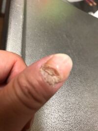 爪が2週間前くらいから 突然根元から取れて酷くなりました これは Yahoo 知恵袋