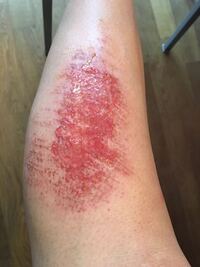 グロいです 2日前にソフトボールの練習があり その時にスラ Yahoo 知恵袋