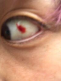 これって結膜下出血ですか 白眼から出血してます 3日 4日 Yahoo 知恵袋
