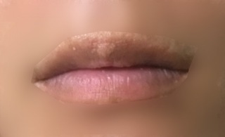 唇のフォアダイスについて写真にあるように唇の上の部分に白い粒が集まってブツ Yahoo 知恵袋