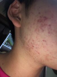 ニキビについてです 皮膚科にいっているのですが全く治りません ど Yahoo 知恵袋