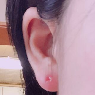 穴 膿む ピアス