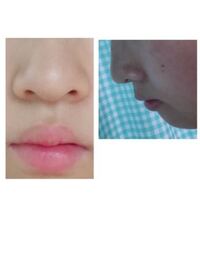 この鼻は低いですか 正面から見て鼻の穴がよく見えます 前歯が出っ Yahoo 知恵袋