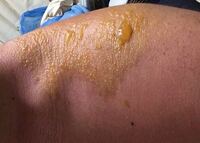 一昨日プールに行って 日焼けしました めっちゃ痛かったので ネットで Yahoo 知恵袋