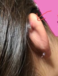 ファーストピアスについて半年間ファーストピアスをつけっぱなしにしてい Yahoo 知恵袋