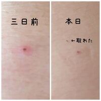 ホクロって剥けるのでしょうか 26歳女です 数ヶ月前に左膝に黒い点を Yahoo 知恵袋