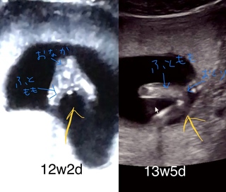 妊娠12週2日目と13週5日目のエコー写真で お股を写しているも Yahoo 知恵袋