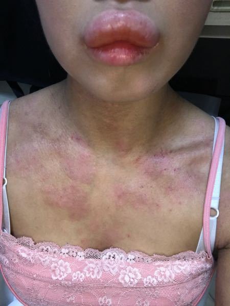 皮膚の病気 アトピー 解決済みの質問 Yahoo 知恵袋