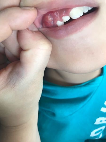子供の歯茎にこんなのが出来てました。 - なんでしょうかこれは1cm 