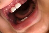 1歳の娘の歯が白くなっています 虫歯でしょうか 歯医者連 Yahoo 知恵袋