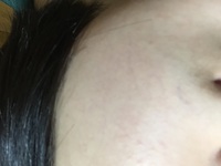 現在女子中学生です 小さい頃から口の周りにたくさんの毛細血管 Yahoo 知恵袋