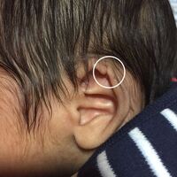 生後3ヶ月の娘の頭が長いんです 帝王切開で出産しました ２６ ３０週まで逆子 Yahoo 知恵袋