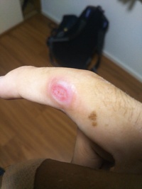 この傷って結構深いですか 絆創膏を貼っていて 何日経っても 傷が小さくなる Yahoo 知恵袋