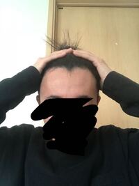 これはエムジはげですか もしくは富士額ですか Helpmeeeeee Yahoo 知恵袋