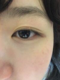 ものもらい 目の病気と治療 ひかる眼科 蕨市中央 ひかる眼科
