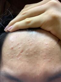ニキビが治りません 一週間前くらいから皮膚科にもらったベピオゲルとい Yahoo 知恵袋