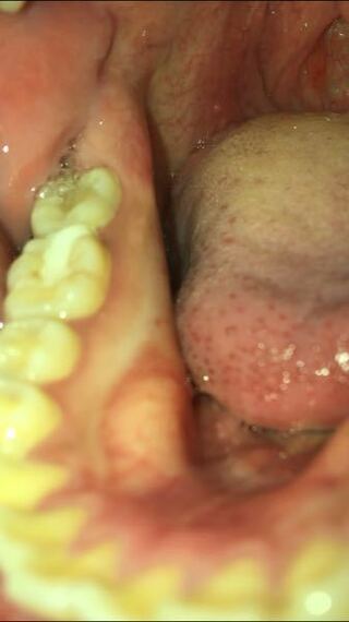 歯茎に白い模様 下の歯の右側の内側の歯肉に白い部分があるので Yahoo 知恵袋