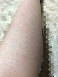 ここまでひどくなった 足の毛穴はどうやってケアしたらいいでしょうか Yahoo 知恵袋