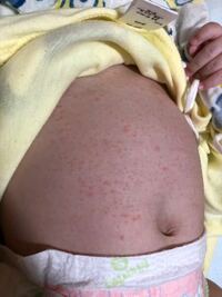 子供の体にブツブツが出来てしまい 小児科受診した所 乳児湿疹と診 Yahoo 知恵袋