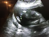 妊娠16週なのですが横向きエコーですこの突起物は男の子の印でしょうか わか Yahoo 知恵袋