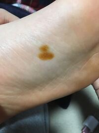 足の裏に急に茶色いシミ みたいなのができて調べてみるとメラノーマという病気 Yahoo 知恵袋