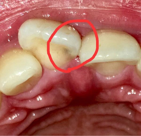 閲覧注意です。この前歯の虫歯はC2くらいですか？(画像あり 