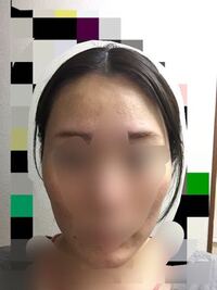 美容師さんでも誰でもハチ張り頭の見分け方教えて下さい この頭はハチ張りです Yahoo 知恵袋