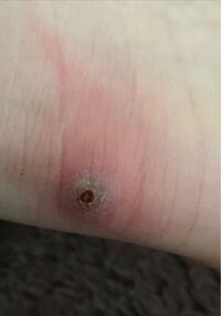 閲覧注意 ローファーで靴擦れしたんですけど 膿んでます Yahoo 知恵袋