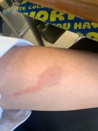 1週間前ほどからこんなふうに尾を引くように晴れています 虫刺されのようで痒くたま 教えて 住まいの先生 Yahoo 不動産