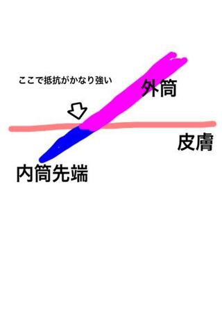 血管確保で たまにサーフローの外筒部分が皮膚に刺さりにくい人がい Yahoo 知恵袋