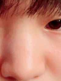 昨日 学校の椅子の背もたれに思いっきし鼻をぶつけて青あざとおでこ Yahoo 知恵袋