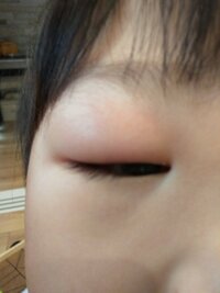 子供が起きたら片目の瞼がはれてました どんどん腫れが進んで今2日目ですがま Yahoo 知恵袋
