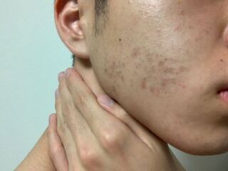 頬の毛を毛抜きで気になって抜いてしまいます この肌の痛んで Yahoo 知恵袋