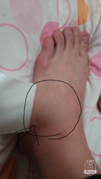 階段で転倒し 足の甲が腫れて痛いです 整形外科へは夕方１番に行きますが Yahoo 知恵袋